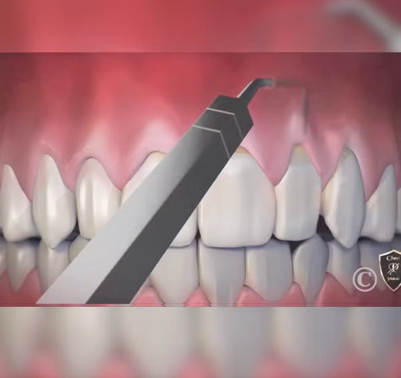 Pinhole Surgical Technique in Oro Valley