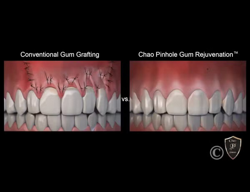 Pinhole Surgical Technique in Oro Valley