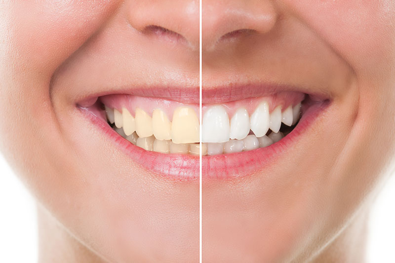 Teeth Whitening in Oro Valley
